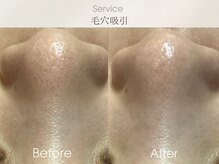 ベルダ(BELDAD)/【黒ずみ毛穴改善】