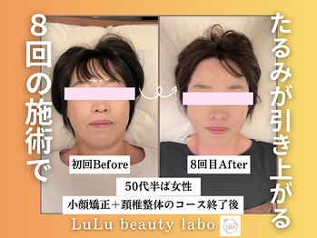 ルルラボ(LuLu beauty labo)/8回でリフトアップ