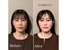 鍼灸院エミュ(Emu)/中顔面が引き締まりました