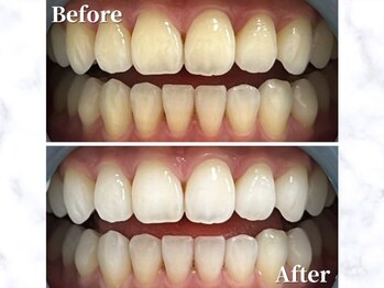 LBSホワイトニング 銀座店/セルフホワイトニングの症例写真