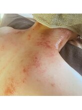 プルトア/かっさ痕