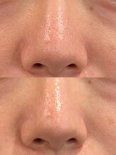 モアビューティー 庚午店(MORE BEAUTY)/症例写真