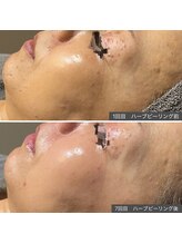 ロッタ エクリュ(Lotta ecru+)/REVI剥けないハーブピーリング