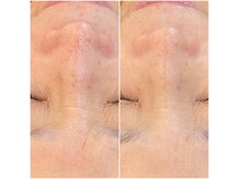 アプリ(APRI)の雰囲気（肌質改善　シワケア　たるみケア　毛穴　赤み　くすみ）