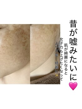 ラウレア(Laule’a)/シミ改善！最新光フェイシャル☆
