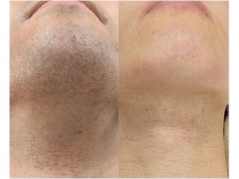 ルルトウキョウ 池袋店(LULU.tokyo)/ひげ脱毛/1回目→8回目