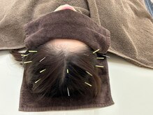 スカイブルー鍼灸接骨院/頭皮鍼