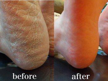 ドクターネイル爪革命 札幌本店/症例紹介30 角質ケア