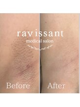 ラヴィソン(ravissant)/脇脱毛