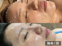 セレブリボーン 大阪ボーテ/セルマンピーリング