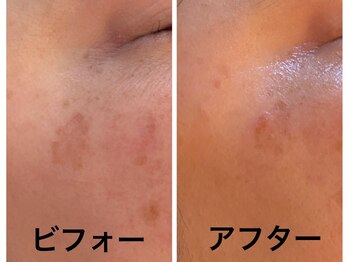 ナオフクオカ ヒーリングフォースエヌ(NaoFukuoka/healingforceN)/20年来のシミが薄く変化!