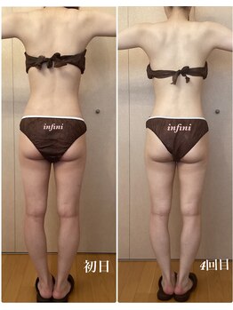 アンフィニ(infini)/短期集中コース全身5回(2ヶ月)