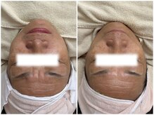 マヴィ 香里園店(MavY.)/ゾンビパック×水光注入