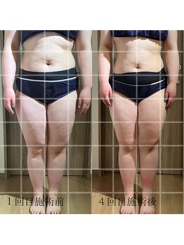 ベルルーナ(Belle-Lune)/ビフォーアフター