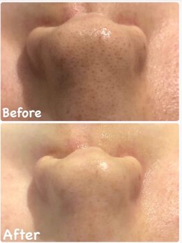 ネオファースト 大阪福島店(NeoFirst)/ハイドラ毛穴洗浄#毛穴#毛穴洗浄