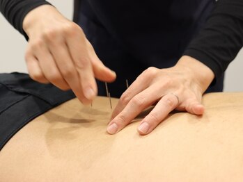 あい鍼灸整骨院 刈谷院の写真/手技では改善が難しいお悩みもお任せ◎鍼灸で深層のツボに直接アプローチ!"肩こり・頭痛改善コース¥4,950"