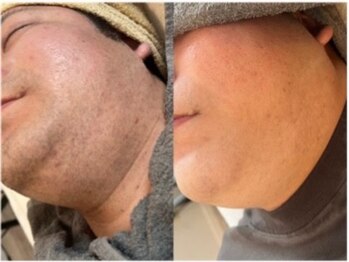 ルルトウキョウ 池袋店(LULU.tokyo)/ひげ脱毛/1回目→12回目