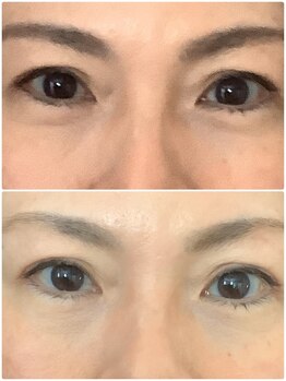 ビューティフルムーン(Beautiful Moon)/二重の幅大きく