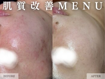 レヴェリー 心斎橋店(REVERIE)/肌質改善コース