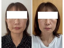 ココ(COCO.)/小顔整顔矯正