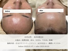 エメ(aimer)/SkinCare《肌管理・エイジング》