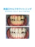 美歯口セルフホワイトニング　初回2回コース　￥8000→￥6000