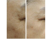 レクラ バイ ドクターエイチ(L'ECLAT by Doctor.H)/ララピール