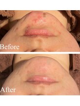 エミルカ 新宿(EMILUCA)/繰り返しニキビにもオススメ