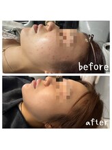 ルビー 池袋店(Ruby)/最新の針入りハーブピーリング