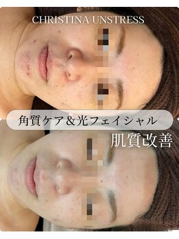 ココリール/角質ケアで肌質改善