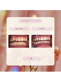 プラスビー 2号店(+b)/ホワイトニングビフォーアフター