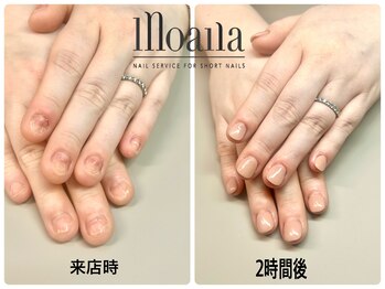 モアナ 池袋(MOANA)/人工爪深爪