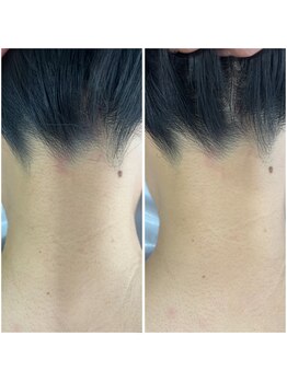 サロン ヴィラ(villa)/#うなじ脱毛#脱毛