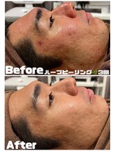 アムール 麻布十番(Amour)/ハーブピーリング3回