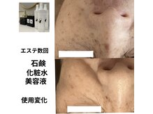 ブルーバケーション(Blue Vacation)の雰囲気(エステ2回 石鹸、美容液、お化粧水使用)