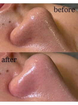 シャルム(CHARME)/ハイドロフェイシャル