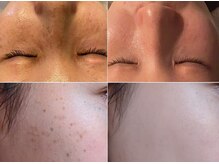 ナチュレアンドメディカ(Nature&Medica)/顔脱毛＋シミケアフェイシャル