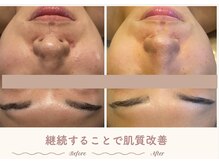 エステティックサロン シーズ/続けるほど肌改善