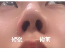 ブリリオ 池袋店(Brillio)/小鼻縮小/一回での効果
