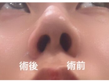 ブリリオ 池袋店(Brillio)/小鼻縮小/一回での効果