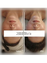 カルナボディ(Carna body.)/たるみ改善でVラインフェイス