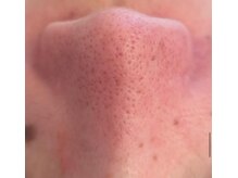 ルチル(Rutile)/韓国式3D毛穴洗浄