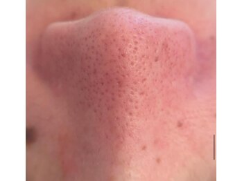 ルチル(Rutile)/韓国式3D毛穴洗浄