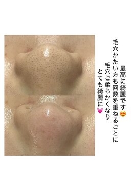 ラウレア(Laule’a)/長年の毛穴悩みも改善！