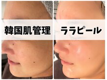 アンノン(Annon)の雰囲気（即日水光肌☆韓国肌管理「ララピール」）