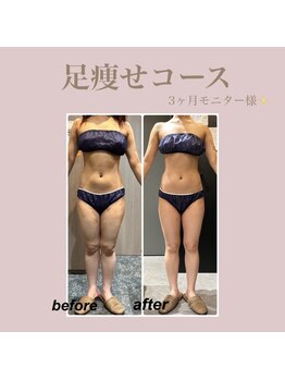 エステティック レイビス 新宿店(RAYVIS)/下半身短期集中★