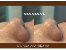 リリアーナ アサヒカワ(LILIANA ASAHIKAWA)/ハイドラ毛穴洗浄＋顔脱毛