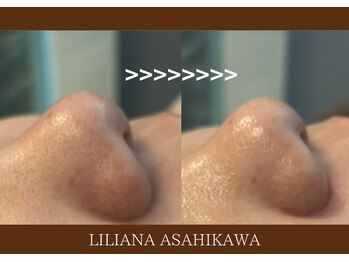 リリアーナ アサヒカワ(LILIANA ASAHIKAWA)/ハイドラ毛穴洗浄＋顔脱毛