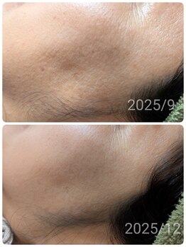 ル クラージュ(Le courage)/光フォト+バクテリウムピール