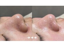 フロラスキン 銀座Miel店(florasKIN)/毛穴洗浄コース